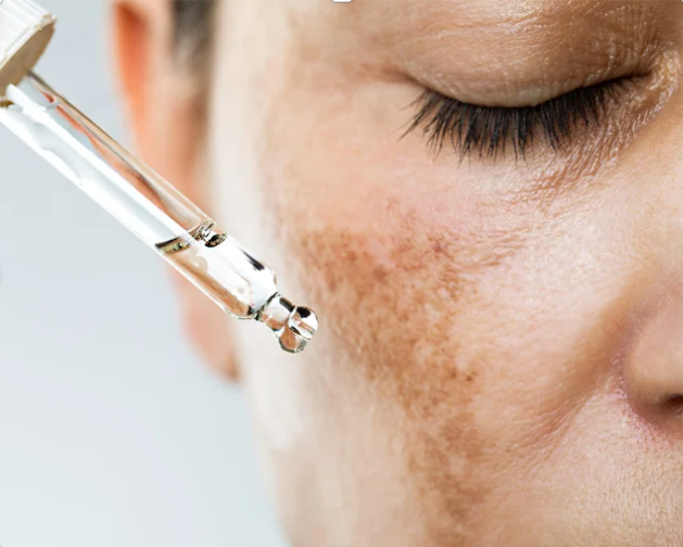 Why Does Hyperpigmentation Become More Noticeable as We Age?