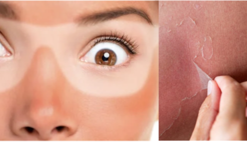 Peeling Skin This Summer? We help you Protect, Nourish & Glow with Frusirnag